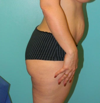 Brazilian Butt Lift- Fat transfer