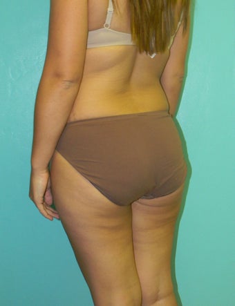 Brazilian Butt Lift- Fat Transfer