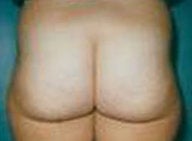 Butt lift