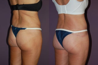 butt lift