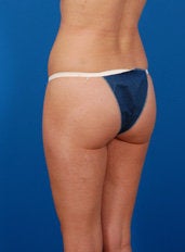 Brazilian Butt Lift