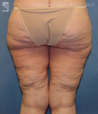 Backlift