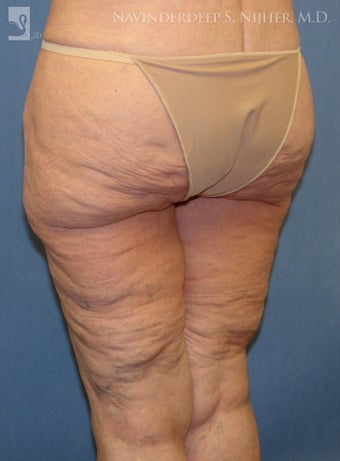 Backlift