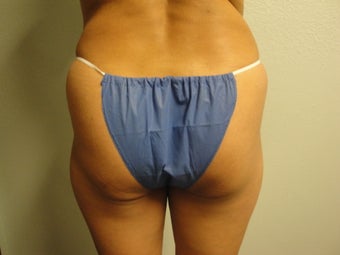 Brazilian Butt Lift 