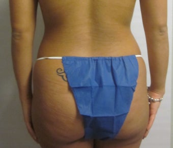 Brazilian Butt Lift 