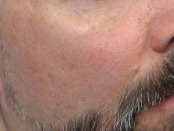 CO2 Fractionated Laser Resurfacing