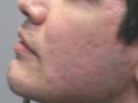 CO2 Fractionated Laser Resurfacing