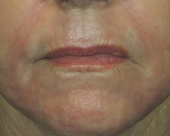 Ridding Lip Lines & Wrinkles with C02 Laser