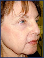 CO2 laser skin resurfacing