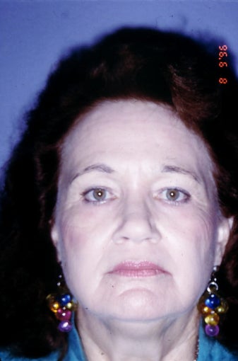 Co2 Laser (skin resurfacing)