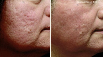 Fraxel Repair for Acne Scars