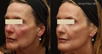 Fraxel Repair for Sun Damage and Minor Laxity