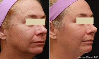 Fraxel Repair CO2 Sun Damage