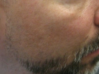 CO2 Fractionated Laser Resurfacing
