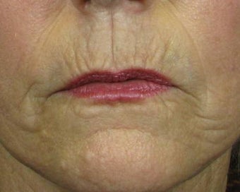 Ridding Lip Lines & Wrinkles with C02 Laser