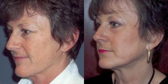 CO2 laser skin resurfacing