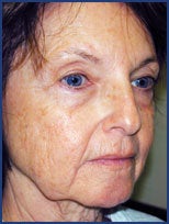 CO2 laser skin resurfacing