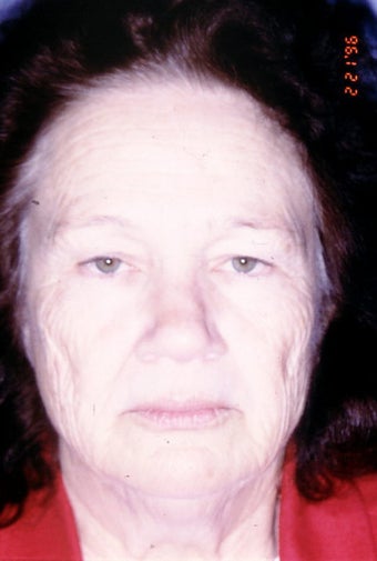 Co2 Laser (skin resurfacing)
