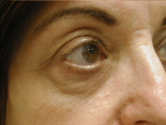 Fractional CO2 Laser Resurfacing - The Madonna Lift