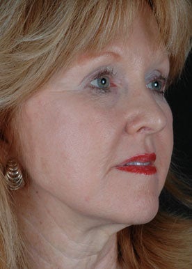 CO2 Laser Resurfacing 