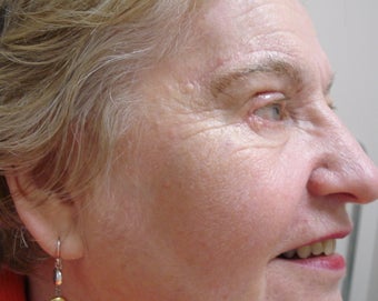DIFF ANGLES - CO2 laser resurfacing with blepharoplasty