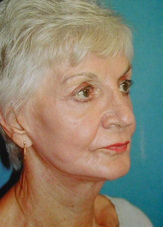 Co2 Laser Skin Resurfacing