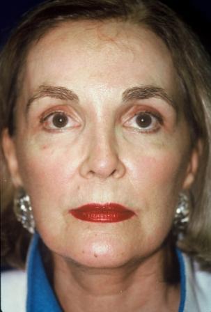 CO2 Laser Resurfacing