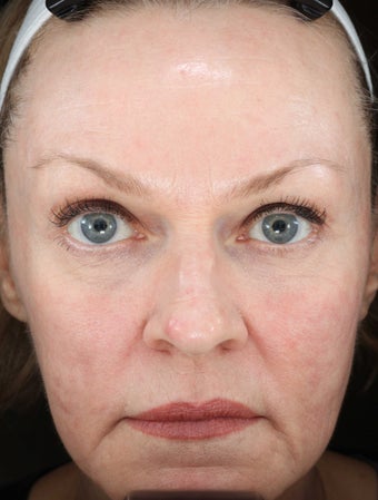 CORE Fractional CO2 Resurfacing