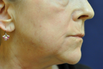 Fractional C02 Laser