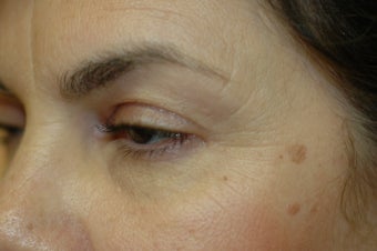 CO2 Laser resurfacing