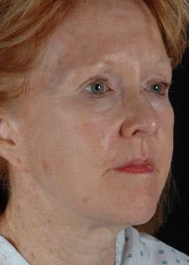 CO2 Laser Resurfacing 