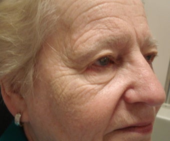DIFF ANGLES - CO2 laser resurfacing with blepharoplasty