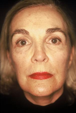 CO2 Laser Resurfacing