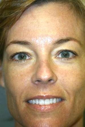 CO2 Laser Resurfacing