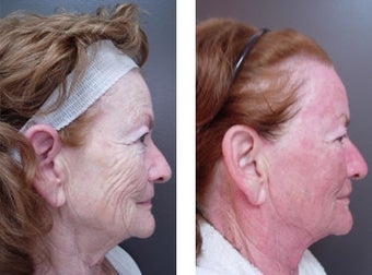 CO2 Fractional Laser