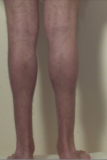 Calf implants