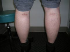 Calf Implants