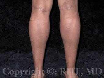 Calf implants