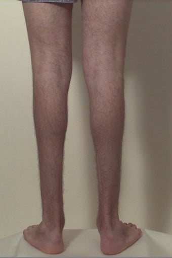 Calf implants
