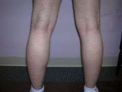 Calf Implants