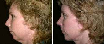44 year old female, chin implant
