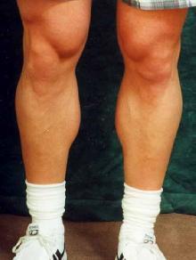 Men's Calf Augmentation 