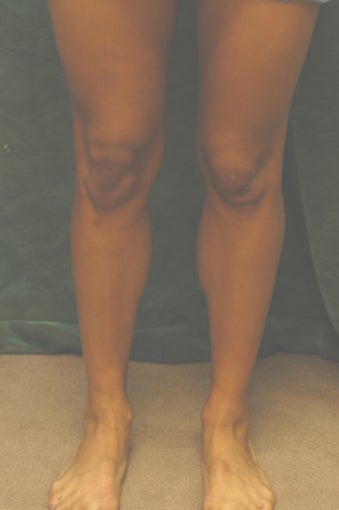 Men's Calf Augmentation  