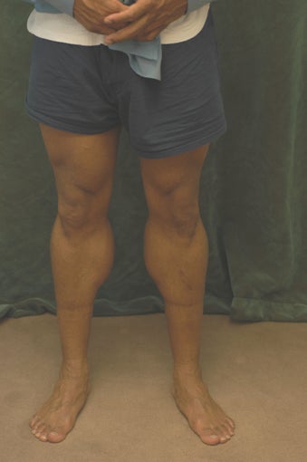 Men's Calf Augmentation 