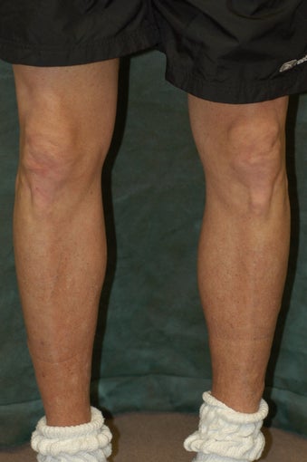 Men's Calf Augmentation  