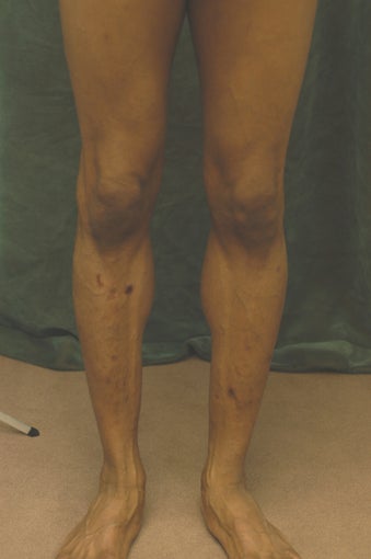Men's Calf Augmentation 