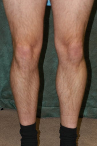 Men's Calf Augmentation 
