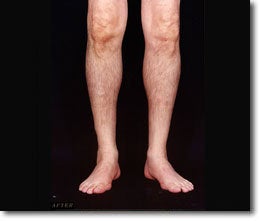 Calf Implant