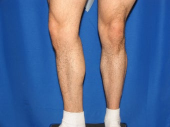 Calf Augumentation