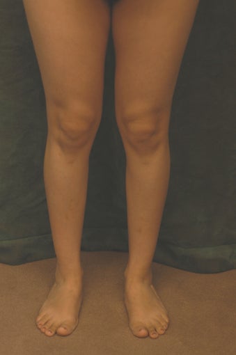 Women's Calf Augmentation 